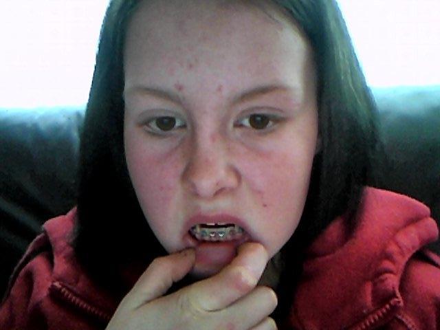 Me with braces (pink and blue LOL !!!!)